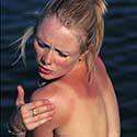 100 pics Holidays answers sunburn