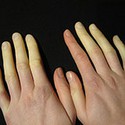 100 pics R Is For answers Raynauds 