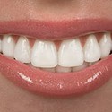100 pics V Is For answers Veneers 